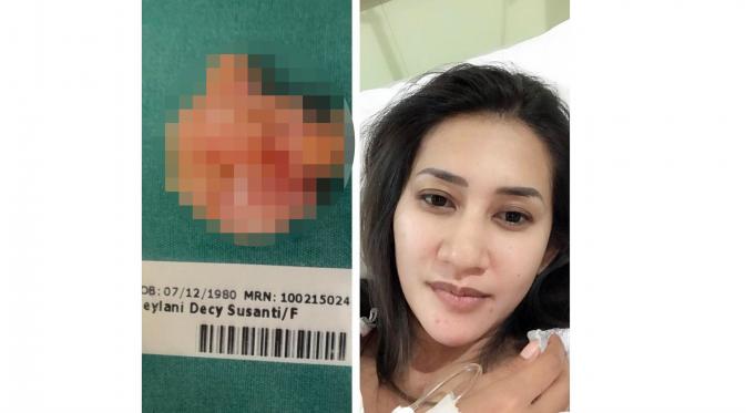 Cut Memey mengunggah foto tumor yang ada di payudaranya dan sudah berhasil diangkat. (Instagram @cutmemey)