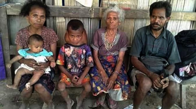 Bocah 6 tahun (kedua dari kiri) asal Desa Mnesatbubu, Kecamatan Polen, Timor Tengah Selatan, NTT, berjuang melawan tumor leher. (Liputan6.com/Ola Keda)