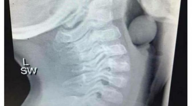 Foto X-ray seorang bocah yang ada anggur tersangkut di lehernya. (Foto: Facebook FinleeandMe)