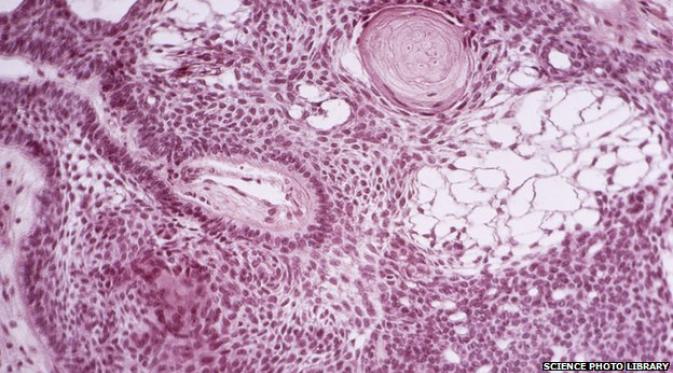 Sel inti atau sel punca dapat mengobati kanker otak (Sumber: www.bbc.com/)