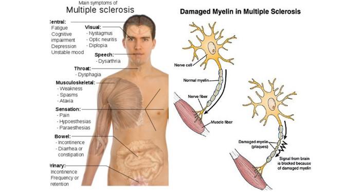 Kerusakan Myelin (Via: braininjury-explanation.com)