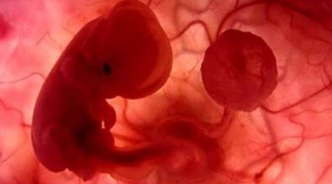 Pengizinan aborsi (Via: zasshi.stikesmuh-pkj.ac.id)