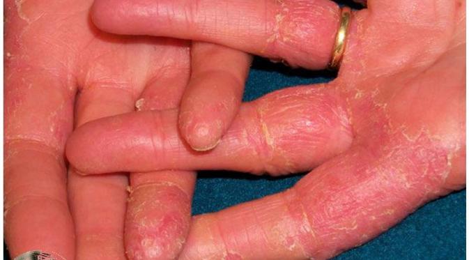 Penyakit kulit | via: arwinokwandiclinic.blogspot.com