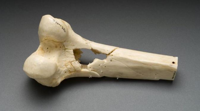 Kerusakan tulang (Via: civilwartalk.com)