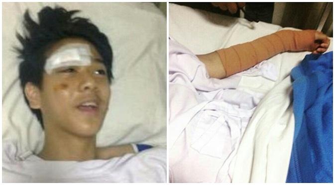 Iqbaal CJR menderita luka-luka dibagian tangan kiri, kaki dan kepala. (via Instagram.com)