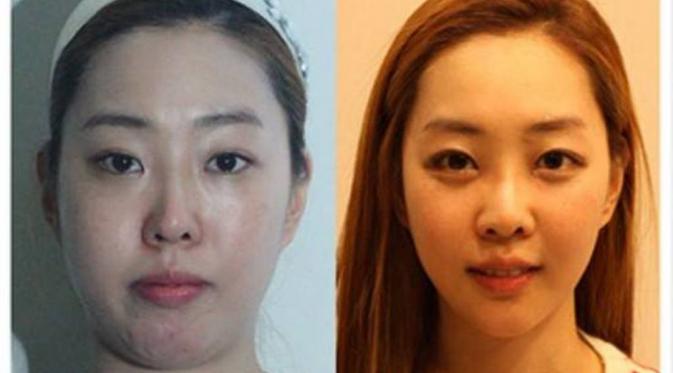 15 Foto Perubahan Wajah Orang Korea Setelah Operasi Pelastik | via: brilio.net