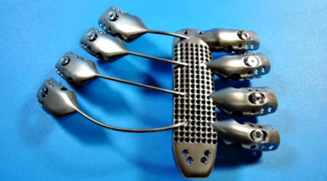 Cetakan rusuk titanium 3D (sumber Anatomics)